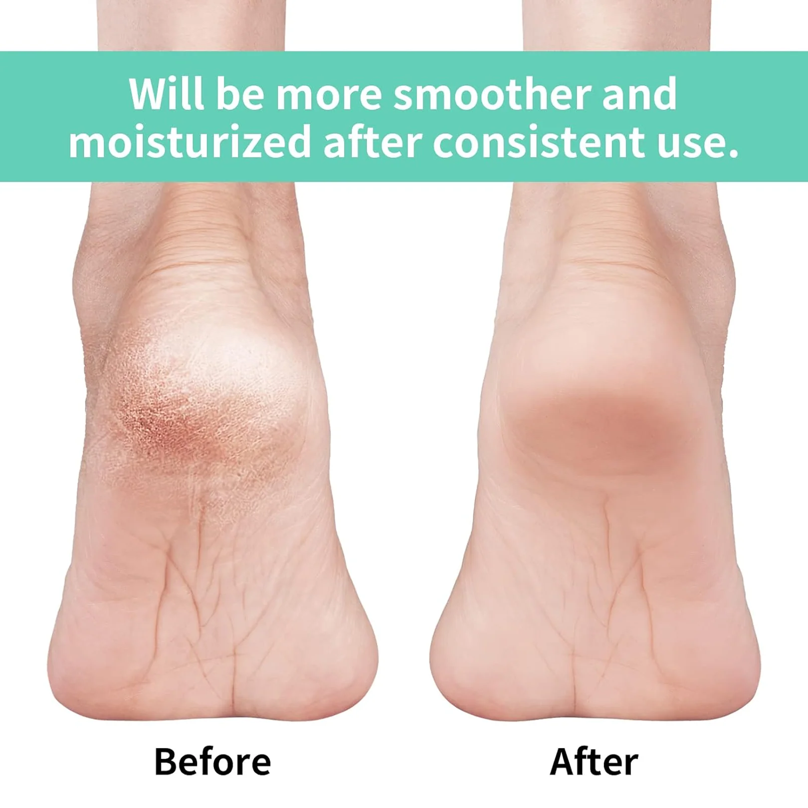 Silicone Gel Heel Socks – Cracked Heels Remedy | Velvet Wheels - Image 3