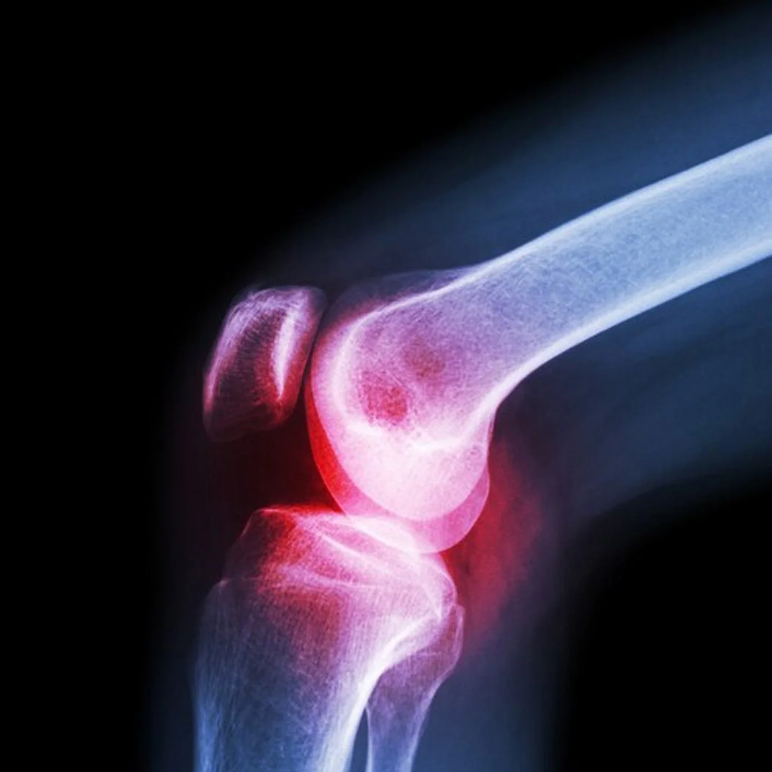 Knee Cap for Support – XL Breathable Joint Brace | Velvet Wellness - Image 6