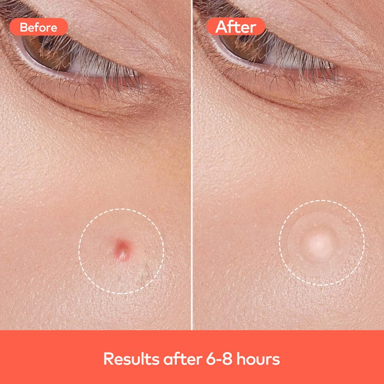 Pimple Patches – Hydrocolloid & Tea Tree Oil for Acne | GlowForm - Image 7